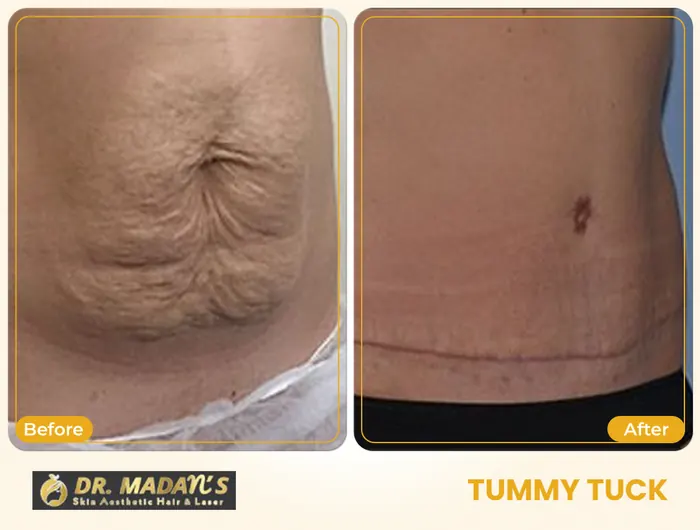Tummy tuck before and after result 5 at Dr Madan Aesthetics